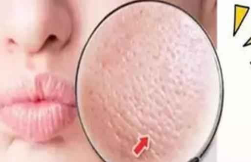 毛孔粗大用食盐有用吗 毛孔粗大敷什么面膜好 毛孔粗大用食盐有用吗 毛孔粗大敷什么面膜好