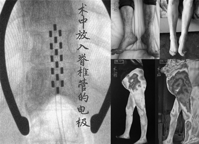 得了糖尿病足,就只能等着截肢吗