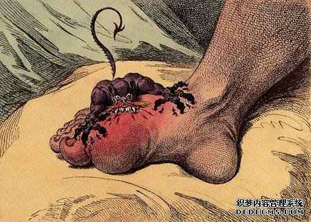 痛风如何快速止痛?特效食疗“两方”,人人家中都有